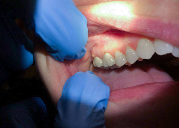 Best Dentist for Tooth Abscess  in Hurley, WI